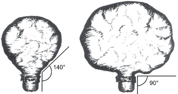 Fig 2- Three Uterii with the  same fundal height but different volumes,due to different AP Diameters and Breadths.