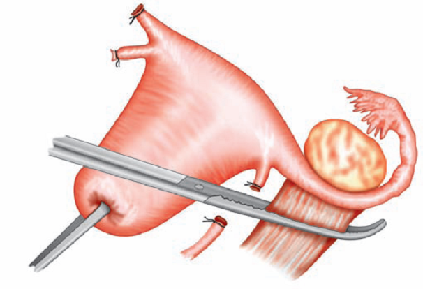 Fig 3-Clamp placed on the infundibulopelvic ligament,after dividing the round ligament laterally